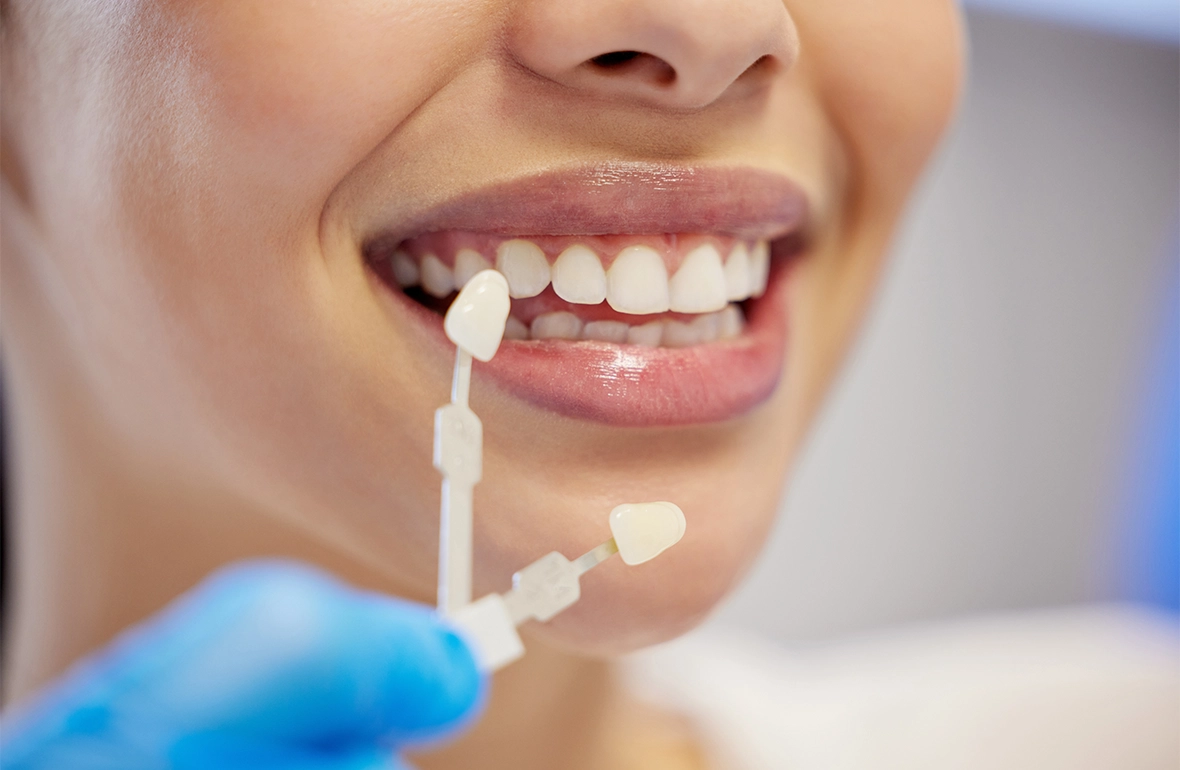 branqueamento-dentario-harmonize-dental-clinic