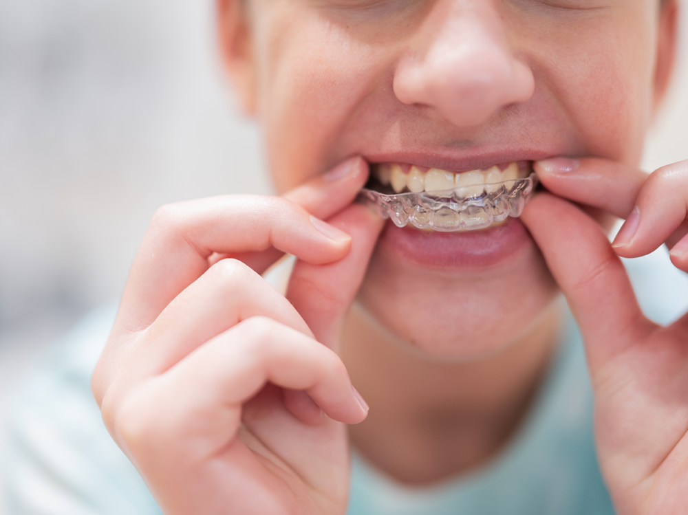aparelhos-invisiveis-harmonize-dental-clinic aparelhos-invisiveis-harmonize-dental-clinic