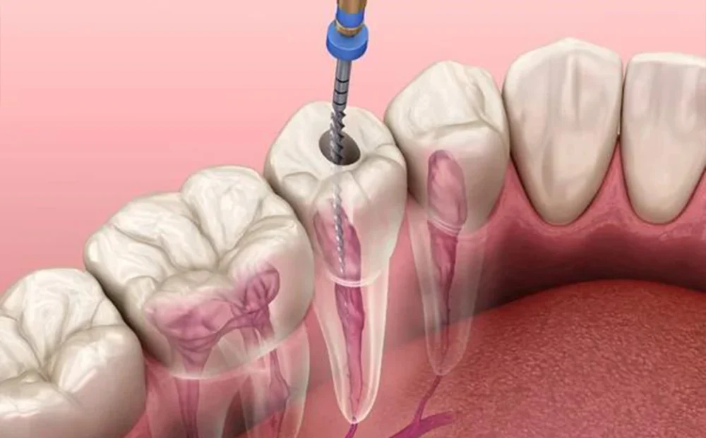 endodontia-harmonize-dental-clinic