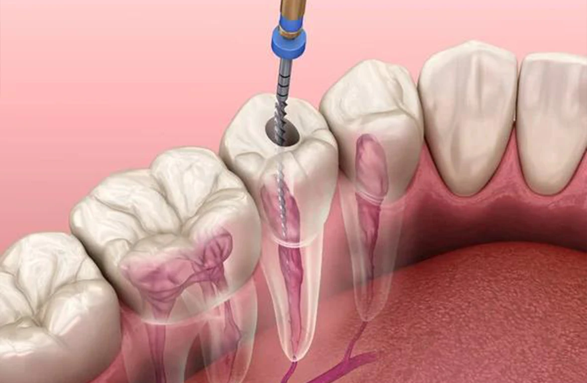 endodontia-harmonize-dental-clinic