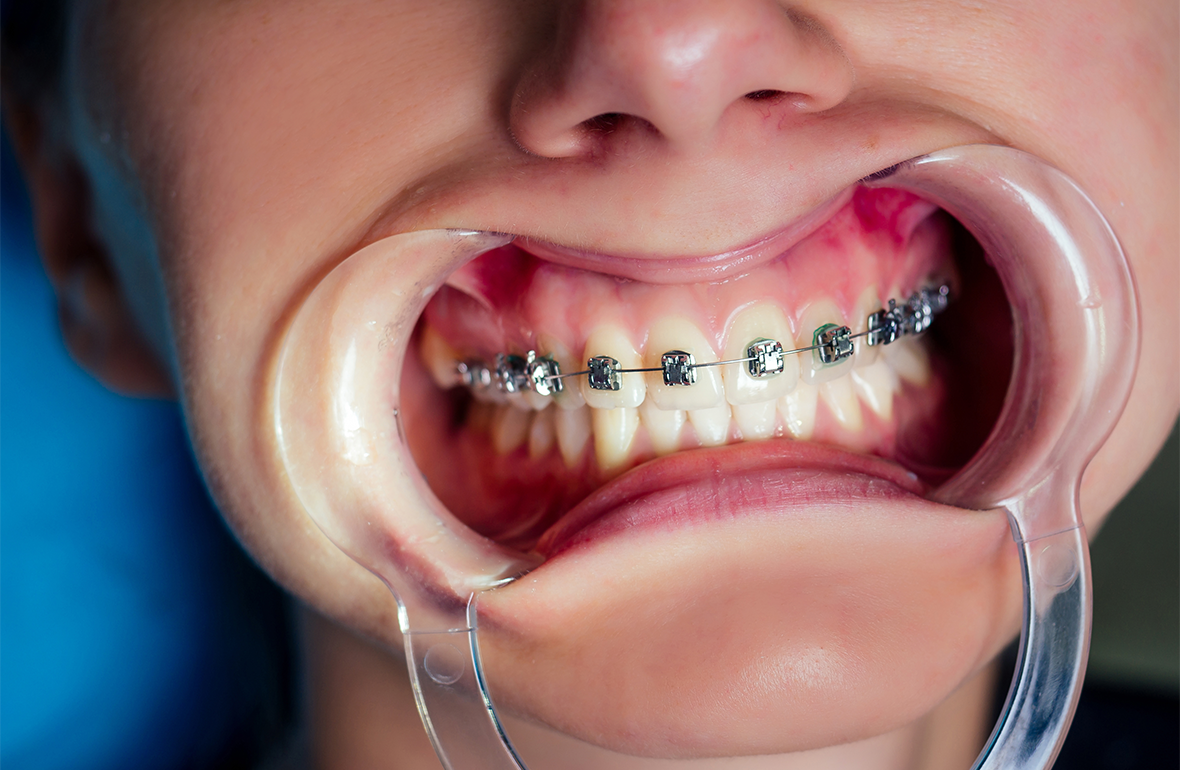 ortodontia-fixa-harmonize-dental-clinic